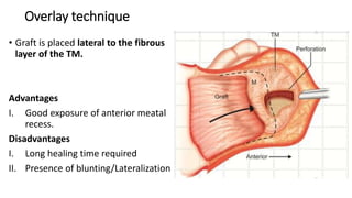 Overlay technique
• Graft is placed lateral to the fibrous
layer of the TM.
Advantages
I. Good exposure of anterior meatal
recess.
Disadvantages
I. Long healing time required
II. Presence of blunting/Lateralization
 