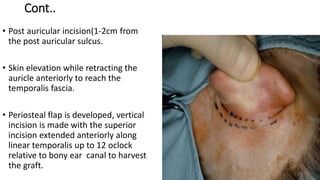 Cont..
• Post auricular incision(1-2cm from
the post auricular sulcus.
• Skin elevation while retracting the
auricle anteriorly to reach the
temporalis fascia.
• Periosteal flap is developed, vertical
incision is made with the superior
incision extended anteriorly along
linear temporalis up to 12 oclock
relative to bony ear canal to harvest
the graft.
 