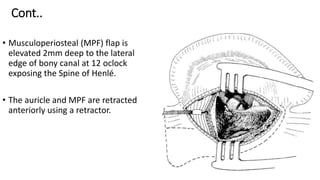 Cont..
• Musculoperiosteal (MPF) flap is
elevated 2mm deep to the lateral
edge of bony canal at 12 oclock
exposing the Spine of Henlé.
• The auricle and MPF are retracted
anteriorly using a retractor.
 