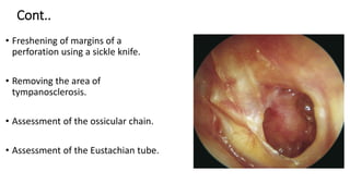 Cont..
• Freshening of margins of a
perforation using a sickle knife.
• Removing the area of
tympanosclerosis.
• Assessment of the ossicular chain.
• Assessment of the Eustachian tube.
 