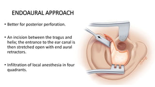 ENDOAURAL APPROACH
• Better for posterior perforation.
• An incision between the tragus and
helix; the entrance to the ear canal is
then stretched open with end aural
retractors.
• Infiltration of local anesthesia in four
quadrants.
 