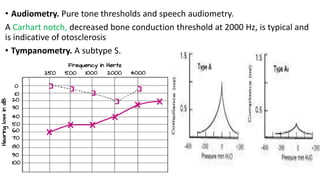 • Audiometry. Pure tone thresholds and speech audiometry.
A Carhart notch, decreased bone conduction threshold at 2000 Hz, is typical and
is indicative of otosclerosis
• Tympanometry. A subtype S.
 