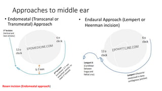 Approaches to middle ear
• Endomeatal (Transcanal or
Transmeatal) Approach
Rosen incision (Endomeatal approach)
• Endaural Approach (Lempert or
Heerman incision)
 