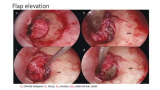 Flap elevation
ct, chorda tympani; in, incus; an, anulus; eac, external ear canal.
 