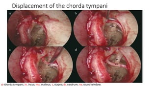 Displacement of the chorda tympani
ct-chorda tympani; in, incus; ma, malleus; s, stapes; dr, eardrum; rw, round window.
 