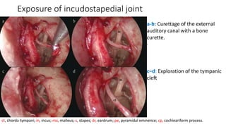 Exposure of incudostapedial joint
a-b: Curettage of the external
auditory canal with a bone
curette.
.
c–d: Exploration of the tympanic
cleft
ct, chorda tympani; in, incus; ma, malleus; s, stapes; dr, eardrum; pe, pyramidal eminence; cp, cochleariform process.
 