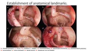 Establishment of anatomical landmarks.
ct, chorda tympani; in, incus; ma, malleus; s, stapes; rw, round window; pe, pyramidal eminence; cp, cochleariform process;
 