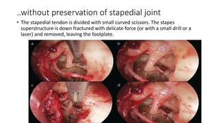 ..without preservation of stapedial joint
• The stapedial tendon is divided with small curved scissors. The stapes
superstructure is down fractured with delicate force (or with a small drill or a
laser) and removed, leaving the footplate.
 