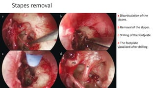 Stapes removal
a Disarticulation of the
stapes.
b Removal of the stapes.
c Drilling of the footplate.
d The footplate
visualized after drilling
 