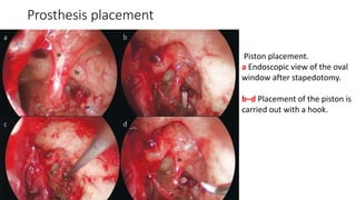 Prosthesis placement
Piston placement.
a Endoscopic view of the oval
window after stapedotomy.
b–d Placement of the piston is
carried out with a hook.
 