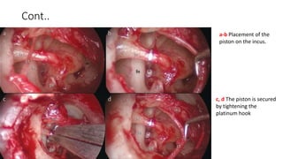 Cont..
a-b Placement of the
piston on the incus.
c, d The piston is secured
by tightening the
platinum hook
 