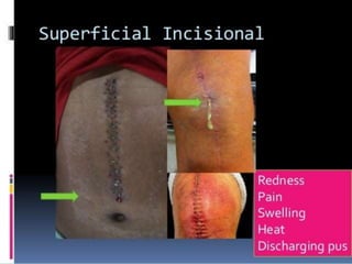 7. Surgical Site Infections.pptx