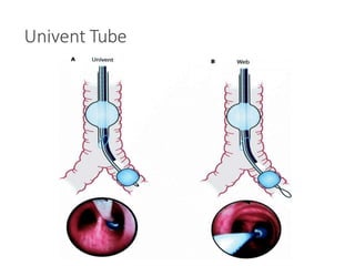Univent Tube
 