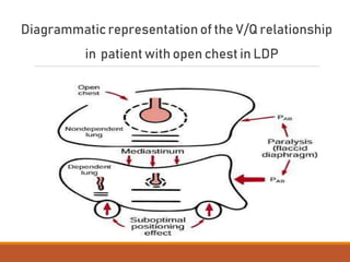 Diagrammatic representation of the V/Q relationship
in patient with open chest in LDP
 
