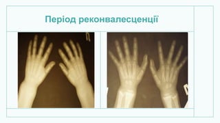 Період реконвалесценції
 