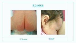 Клініка
• Еритема • Гнейс
 