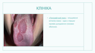 КЛІНІКА
• «Географічний язик» - злущування
епітелію язика – один з перших
проявів ушкодження слизових
оболонок.
 