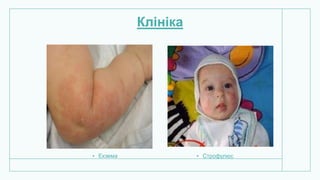 Клініка
• Екзема • Строфулюс
 