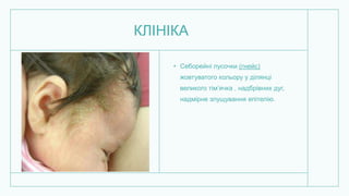 КЛІНІКА
• Себорейні лусочки (гнейс)
жовтуватого кольору у ділянці
великого тім’ячка , надбрівних дуг,
надмірне злущування епітелію.
 