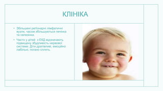 КЛІНІКА
• Збільшені реґіонарні лімфатичні
вузли, часом збільшуються печінка
та селезінка.
• Часто у дітей з ЕКД відзначають
підвищену збудливість нервової
системи. Діти дратівливі, емоційно
лабільні, погано сплять.
 