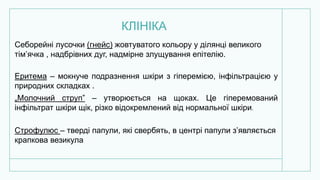 КЛІНІКА
Себорейні лусочки (гнейс) жовтуватого кольору у ділянці великого
тім’ячка , надбрівних дуг, надмірне злущування епітелію.
Еритема – мокнуче подразнення шкіри з гіперемією, інфільтрацією у
природних складках .
„Молочний струп” – утворюється на щоках. Це гіперемований
інфільтрат шкіри щік, різко відокремлений від нормальної шкіри.
Строфулюс – тверді папули, які свербять, в центрі папули з’являється
крапкова везикула
 