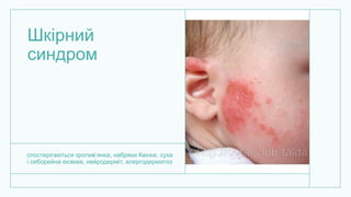 Шкірний
синдром
спостерігаються кропив’янка, набряки Квінке, суха
і себорейна екзема, нейродерміт, алергодерматоз
 