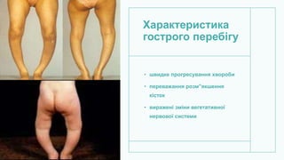 Характеристика
гострого перебігу
• швидке прогресування хвороби
• переважання розм”якшення
кісток
• виражені зміни вегетативної
нервової системи
 