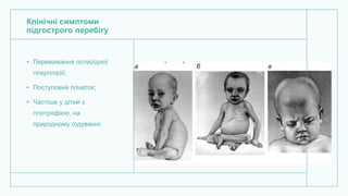 Клінічні симптоми
підгострого перебігу
• Переважання остеоїдної
гіперплазії;
• Поступовий початок;
• Частіше у дітей з
гіпотрофією, на
природному годуванні;
 
