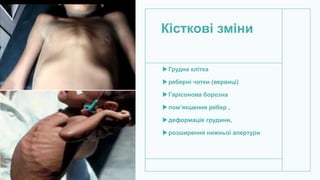 Кісткові зміни
Грудна клітка
реберні чотки (вервиці)
Гарісонова борозна
пом’якшення ребер ,
деформація грудини,
розширення нижньої апертури
 