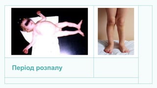 Період розпалу
 