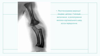 • Рентгенограмма верхньої
кінцівки дитини 7 місяців:
витончення и розгалуження
волокон кортикального шару
кісток передпліччя.
 