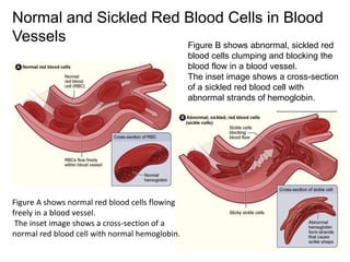 Normal and Sickled Red Blood Cells in Blood
Vessels
Figure A shows normal red blood cells flowing
freely in a blood vessel.
The inset image shows a cross-section of a
normal red blood cell with normal hemoglobin.
Figure B shows abnormal, sickled red
blood cells clumping and blocking the
blood flow in a blood vessel.
The inset image shows a cross-section
of a sickled red blood cell with
abnormal strands of hemoglobin.
 
