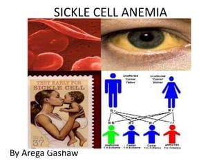 SICKLE CELL ANEMIA
By Arega Gashaw
 