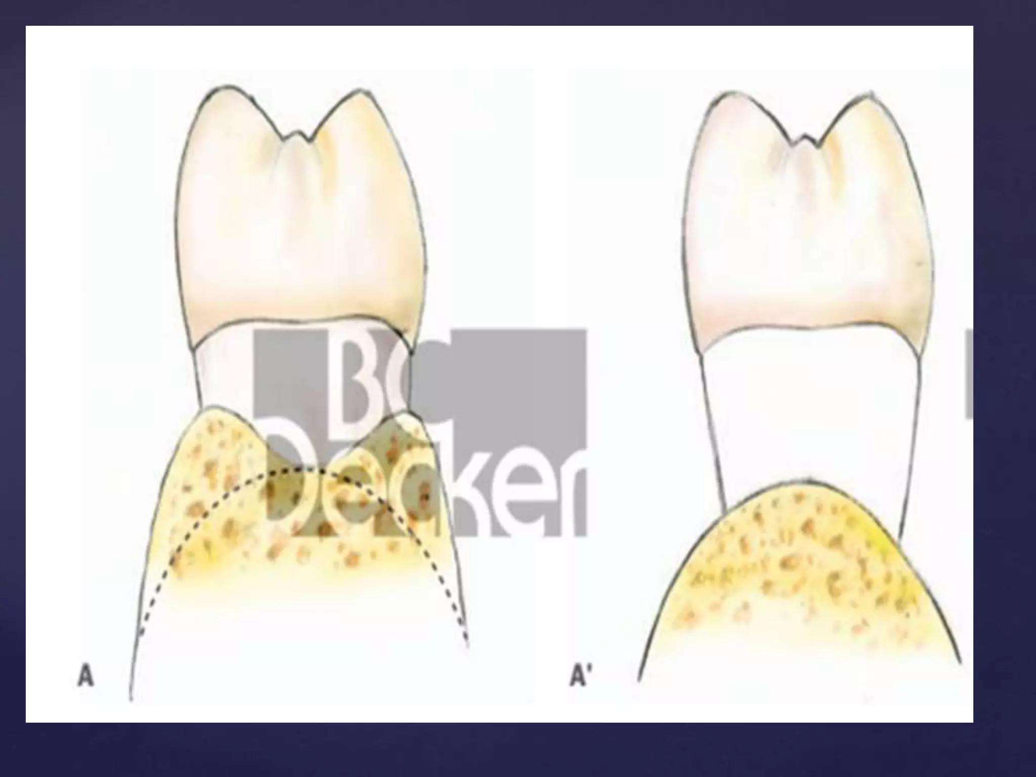 7. Remodeling Resective Osseous Surgery.pptx