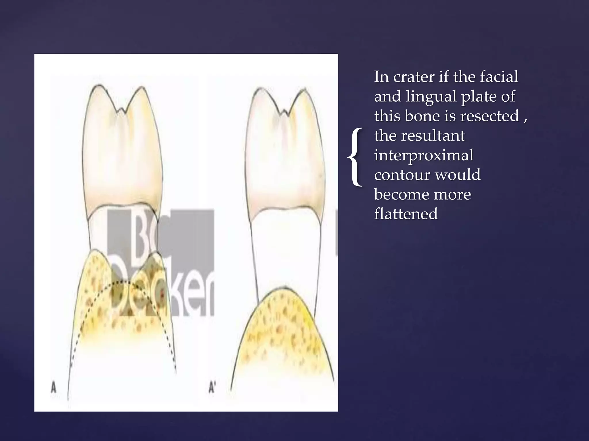 7. Remodeling Resective Osseous Surgery.pptx