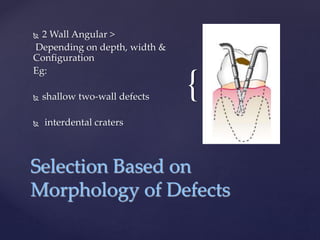 {
 2 Wall Angular >
Depending on depth, width &
Configuration
Eg:
 shallow two-wall defects
 interdental craters
Selection Based on
Morphology of Defects
 