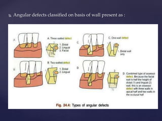  Angular defects classified on basis of wall present as :
 