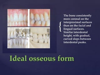 {
The bone consistently
more coronal on the
interproximal surfaces
than on the facial and
lingual surfaces.
Similar interdental
height, with gradual,
curved slops between
interdental peaks.
Ideal osseous form
 