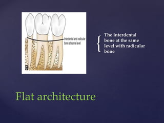 {
The interdental
bone at the same
level with radicular
bone
Flat architecture
 