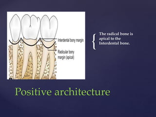 {
The radical bone is
apical to the
Interdental bone.
Positive architecture
 