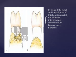 {
In crater if the facial
and lingual plate of
this bone is resected ,
the resultant
interproximal
contour would
become more
flattened
 