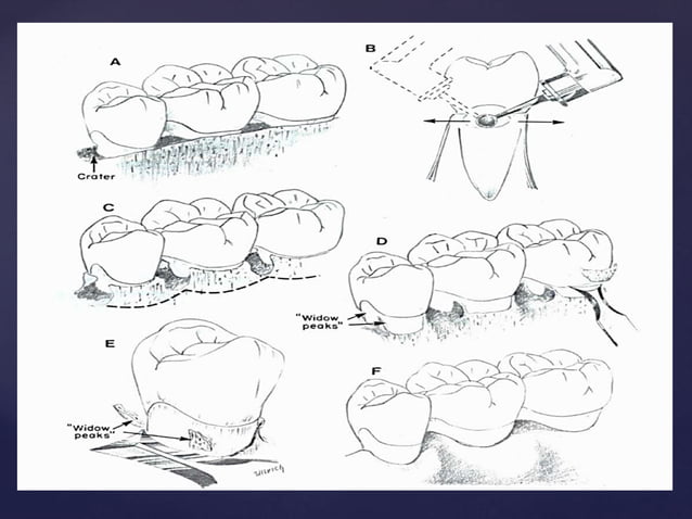 7. Remodeling Resective Osseous Surgery.pptx
