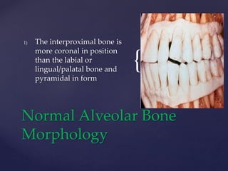 {
1) The interproximal bone is
more coronal in position
than the labial or
lingual/palatal bone and
pyramidal in form
Normal Alveolar Bone
Morphology
 