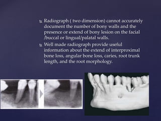 Radiograph ( two dimension) cannot accurately
document the number of bony walls and the
presence or extend of bony lesion on the facial
/buccal or lingual/palatal walls.
 Well made radiograph provide useful
information about the extend of interproximal
bone loss, angular bone loss, caries, root trunk
length, and the root morphology.
 