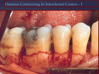 Osseous Contouring In Interdental Craters - I
 