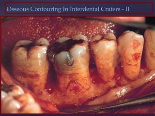 Osseous Contouring In Interdental Craters - II
 