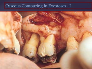Osseous Contouring In Exostoses - I
 
