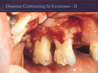 Osseous Contouring In Exostoses - II
 