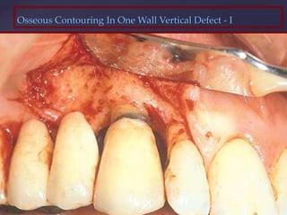 Osseous Contouring In One Wall Vertical Defect - I
 