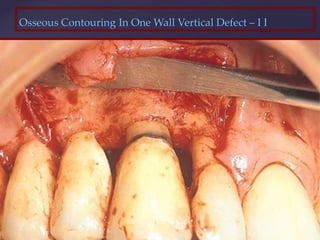 Osseous Contouring In One Wall Vertical Defect – I I
 